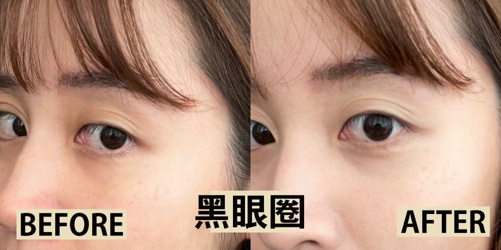 黑眼圈