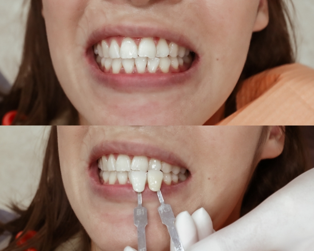 【牙齒冷光美白】漾潔牙醫診所，牙齒美白初體驗，心得評價分享