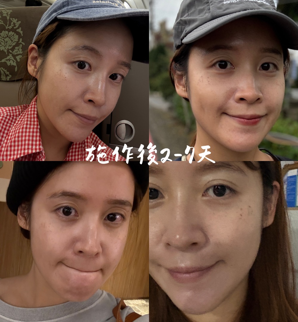 台北皮秒蜂巢雷射推薦｜幸衍醫美診所 專業團隊 量身訂製無瑕美肌