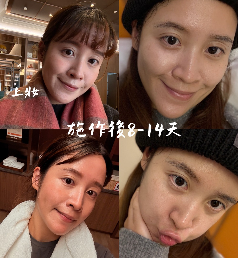 台北皮秒蜂巢雷射推薦｜幸衍醫美診所 專業團隊 量身訂製無瑕美肌