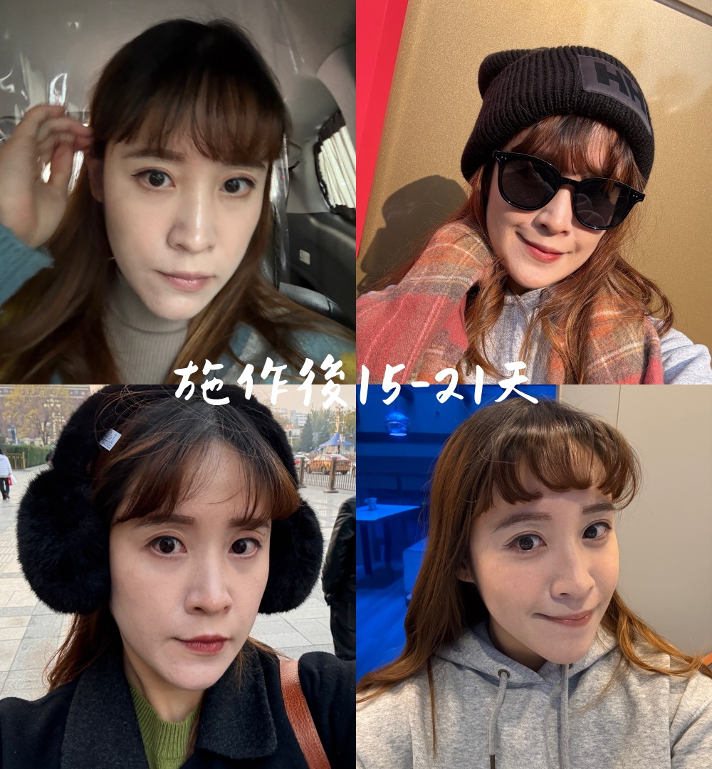 台北皮秒蜂巢雷射推薦｜幸衍醫美診所 專業團隊 量身訂製無瑕美肌